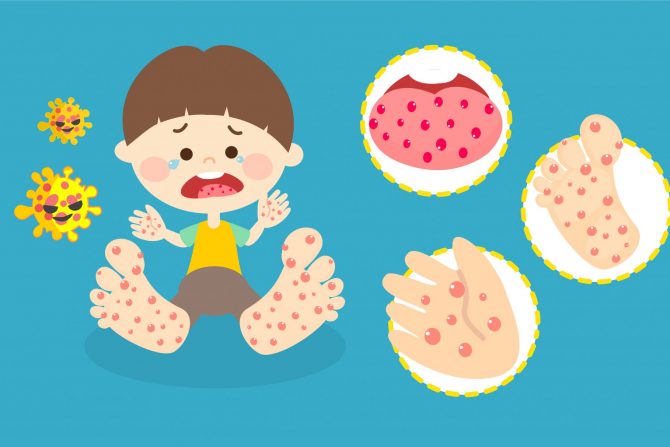 BRNU virus- bolest ruku, nogu i usta- dečja infekcija