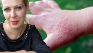 Ekcem dishidroza je bolest kože za koju dr Svetlana Minić kaže da je zapravo alergijska reakcija