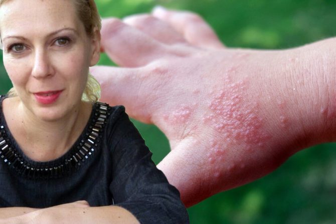 ekcem dishidroza- bolest kože- alergijska reakcija