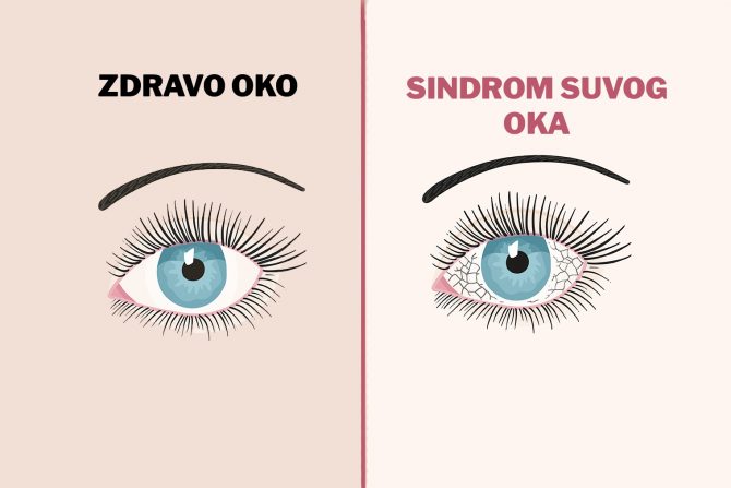 sindrom suvog oka- simptomi- katarakta