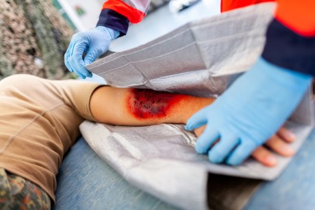 Opekotine, vatra, prva pomoć