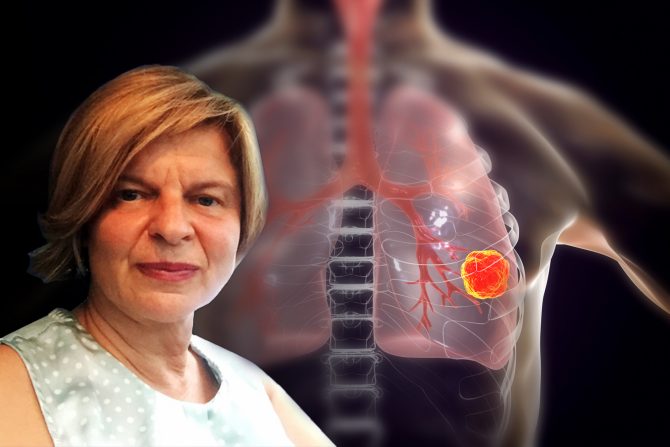 Dr Ana Stojanović, pluća, pušenje, karcinom