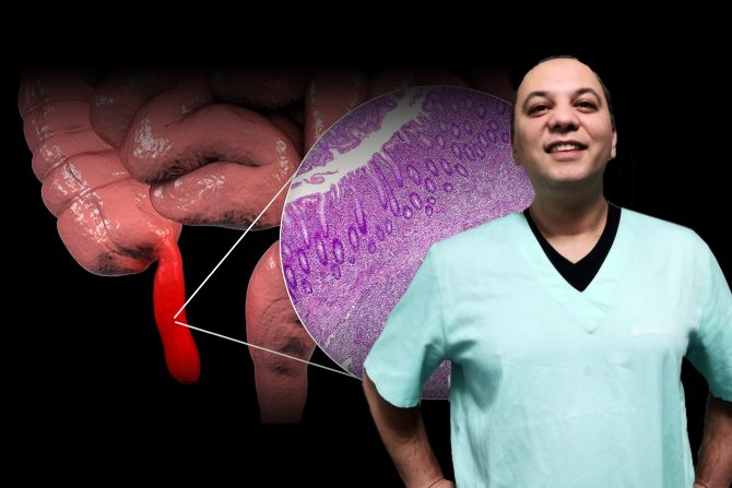 Dr Zlatko Bokun, slepo crevo, crvuljak