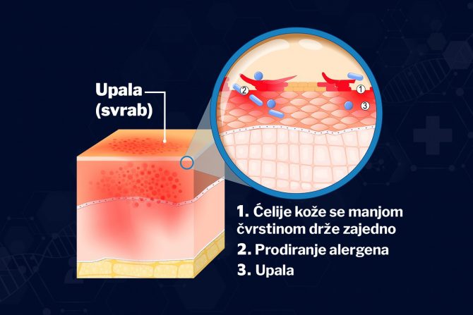 duringova bolest - celijakija-dermatitis