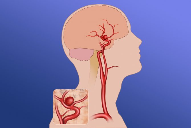 aneurizm mozga- proširenje krvih sudova- pucanje arterija