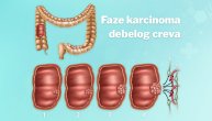 Karcinom debelog creva sve češći kod mlađih osoba. Na ove simptome treba odmah reagovati