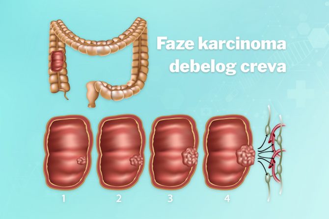 debelo crevo-rak debelog creva- mladi ljudi