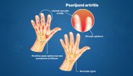 Psorijazni artritis prstiju prvo zahvata male zglobove šake