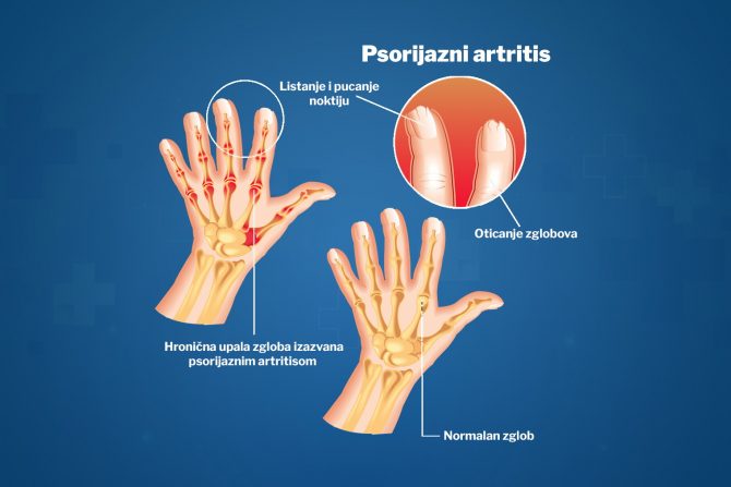 psorijazni artritis prstiju-psorijaza-lek