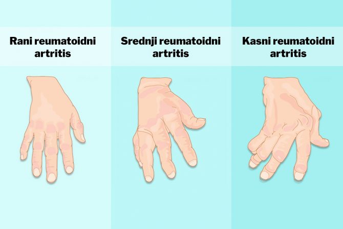 Artritis, bol, zglobovi