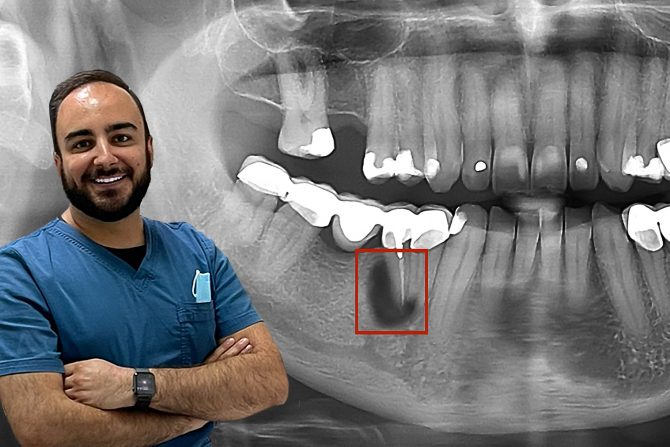 Gagrena zuba, dr Ivan Stanić