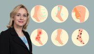 Sindrom nemirnih nogu je, kaže dr Jasmina Jović, osećaj raznih nelagodnosti u nogama tokom mirovanja