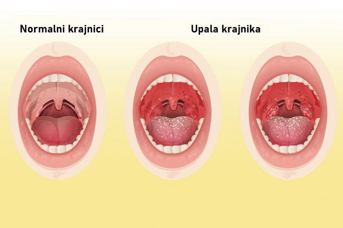 krajnici-upala krajnika- operacija krajnika
