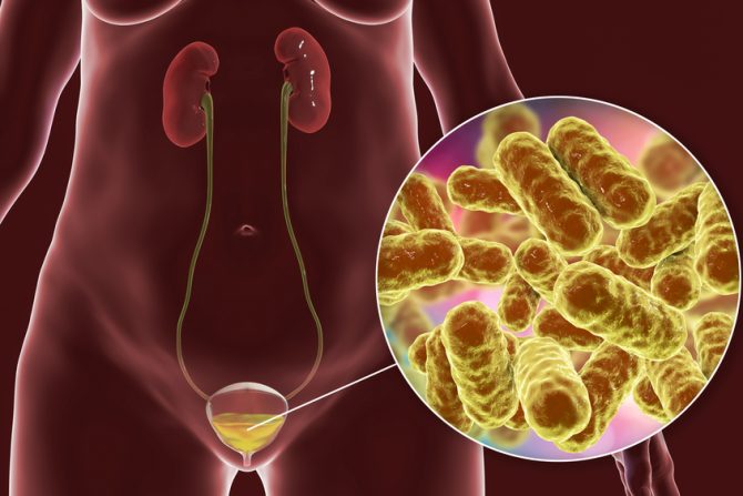 Cistitis, emfizematozni cistitis