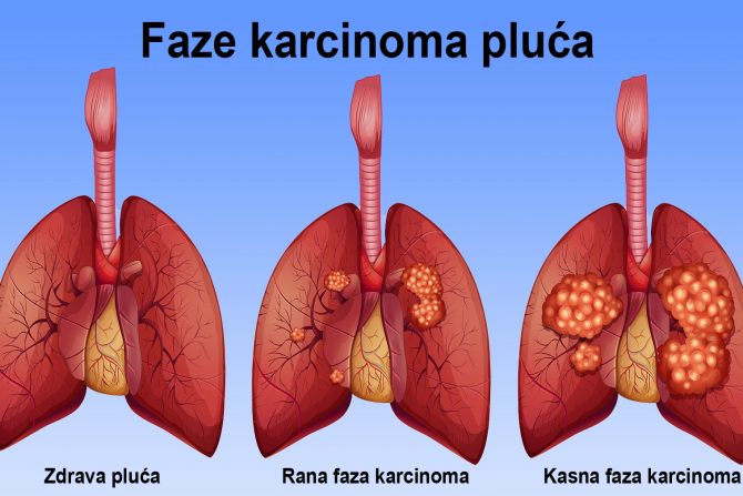 rakpluća- genetska predispozicija- nasledni faktor