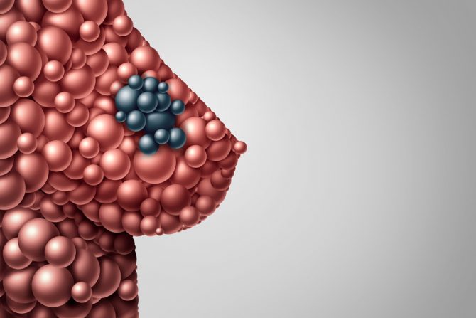 rak dojke- karcinom dojke- pušenje