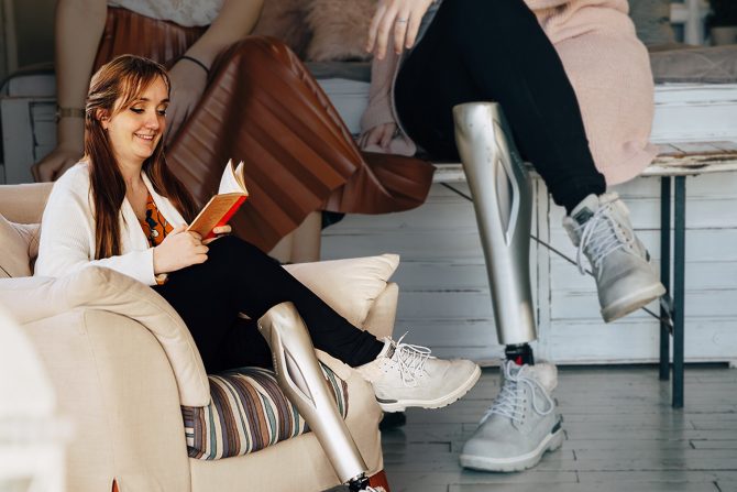 Bojana Ćorilić- život bez noge-veštačka noga