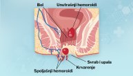 Hemoroidi nastaju na više načina, a najčešći je naprezanje radi pražnjenja creva