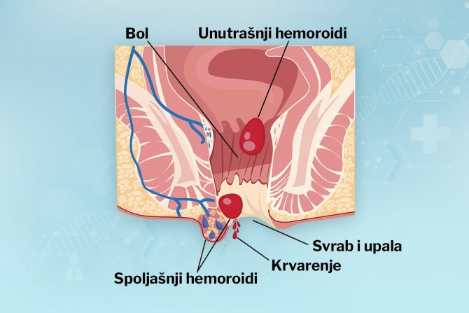hemoroidi-trudnoća.naprezanje-pražnjenje creva