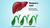 Bolesti žučne kese obuhvataju upale, infekcije, a najčešće stvaranje kamenja