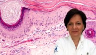 Biopsija kože radi se u slučaju promena koje najčešće nisu vidljive, naglašava dr Snežana Radanović