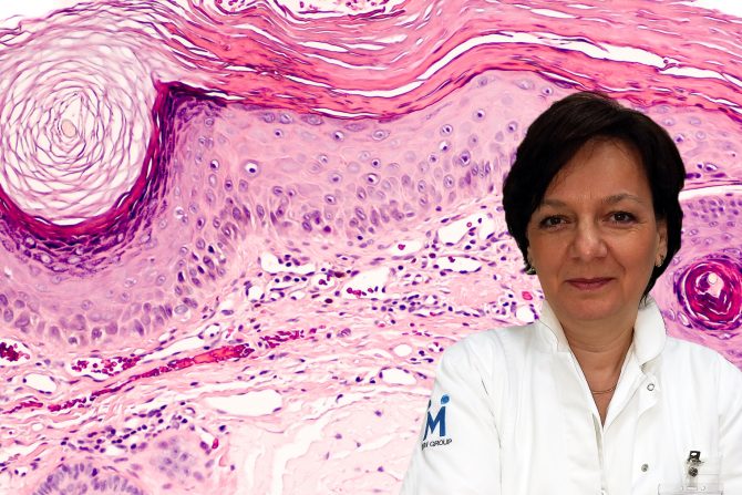 Dr Snežana Radanović, biopsija kože