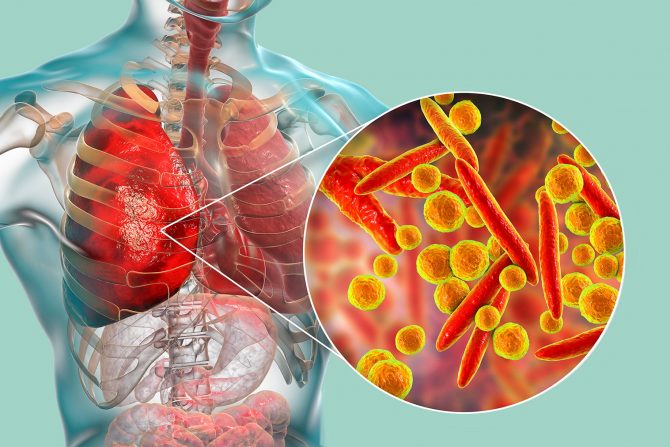 upala pluća- zarazna bolest-