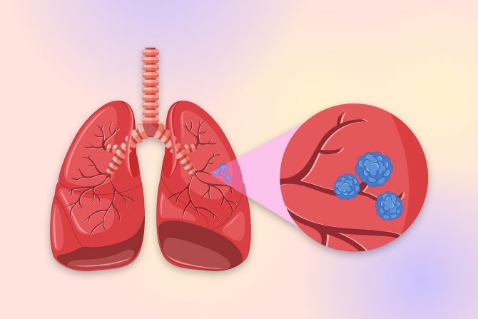 rak pluća-nepušači-uzroci pojave raka kod nepušača