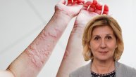 Čitaoci pitaju: Da li koprivnjača može da ugrozi život, sve detalje zna dr Snežana Nedeljković