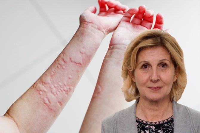 koprivnjača-urtikarija-