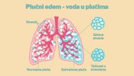 Plućni edem ili voda u plućima nastaje kada tečnost „poplavi“ alveole, a disanje postane sve teže