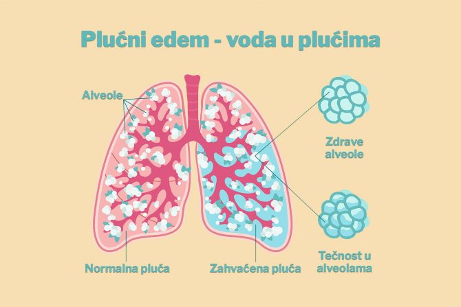 voda u plućima- edem pluća- otežano disanje