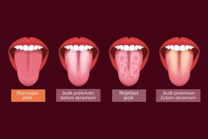 jezik- boja jezika- otkriva bolesti