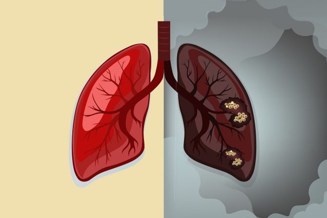 rak pluća -ko su rizične osobe