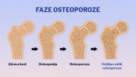 Osteopenija i osteoporoza su dva različita stanja koja utiču na kosti