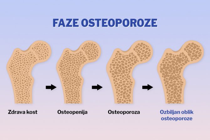 osteoporoza-osteopenija- razgradnja kostiju