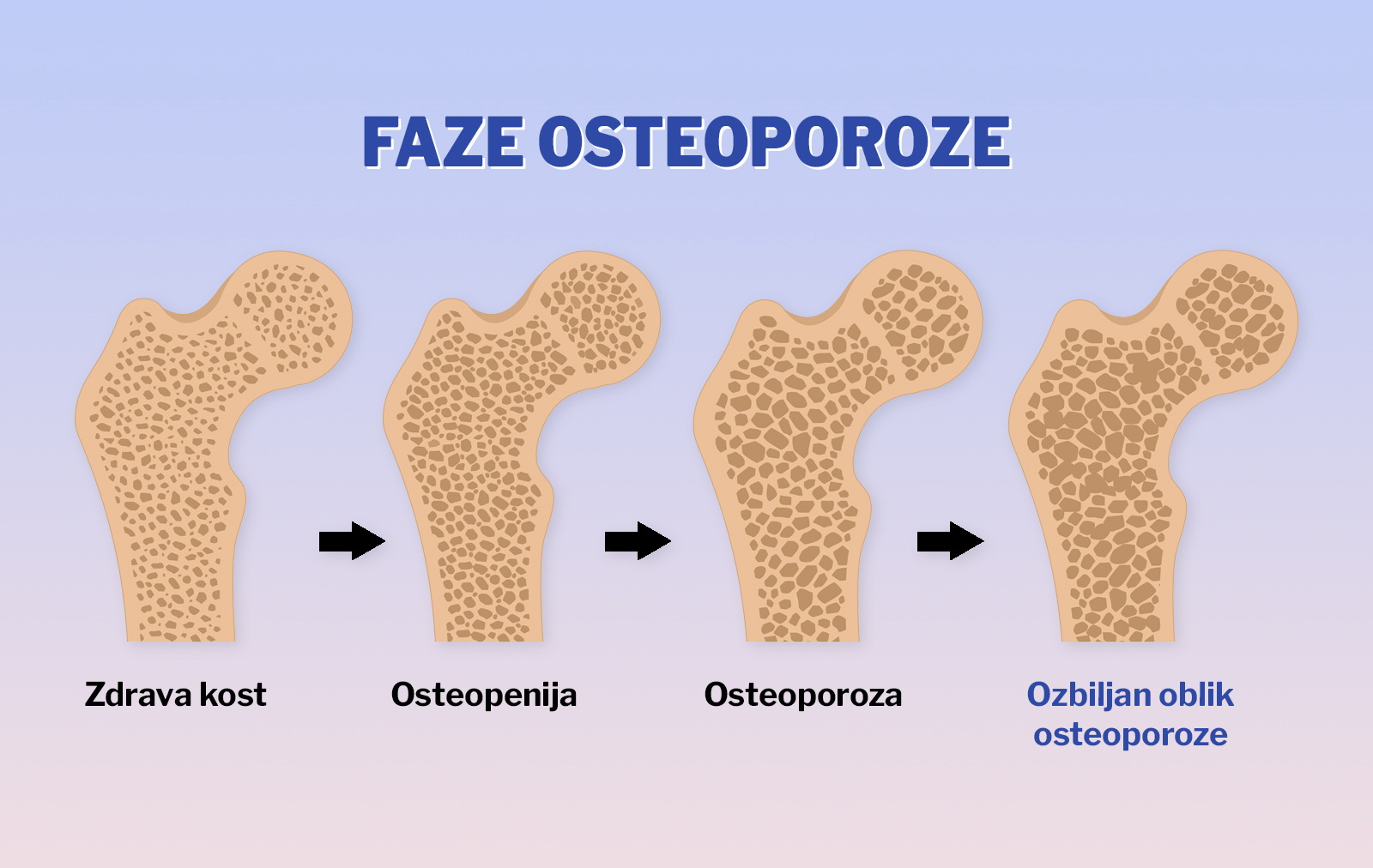 Usporedba faza osteoporoze u gornjem dijelu bedrene kosti, prikazujući progresivno propadanje gustoće kosti od zdrave do ozbiljne.