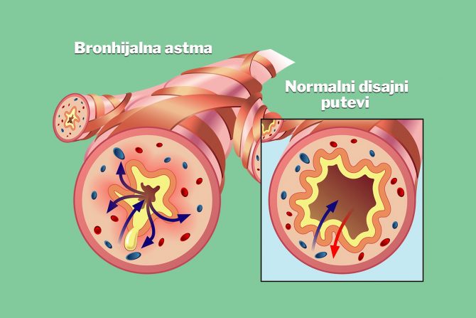 zviždanje u grudima-sviranje-astma