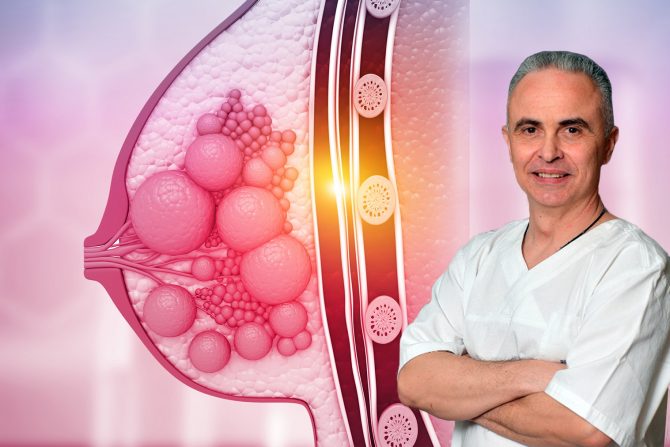 benigna oboljenja dojki-zašto nastaju -dr miloš počekovac