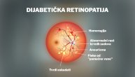 Zabrinjavajući broj mladih sa dijabetesom tipa 2 ima oštećenje oka