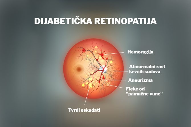 dijabetička retinopatija- slepilo- vid