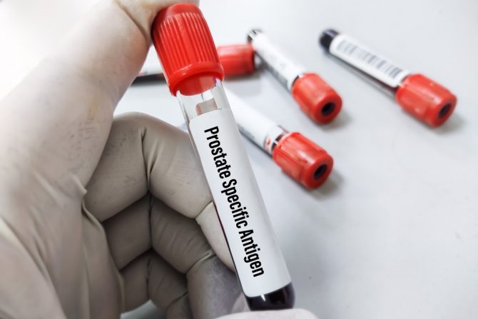 rak prostate - tets