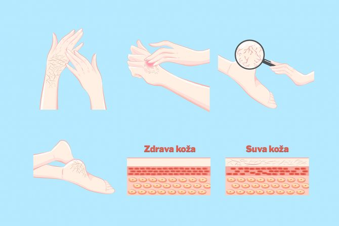 uzrok svraba ruku i nogu