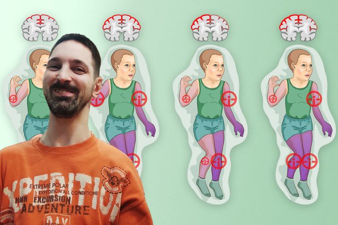 Predrag Damnjanović, spastična cerebralna paraliza