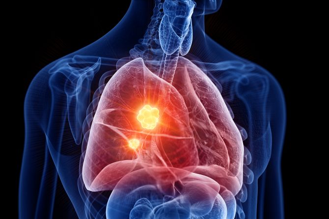 rak pluća- zašto nepušači dobiju rak