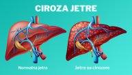 Ciroza jetre je poslednja faza ožiljaka na tkivu, a ako se ne leči, dolazi do otkazivanja organa