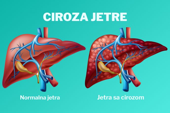ciroza jetre
