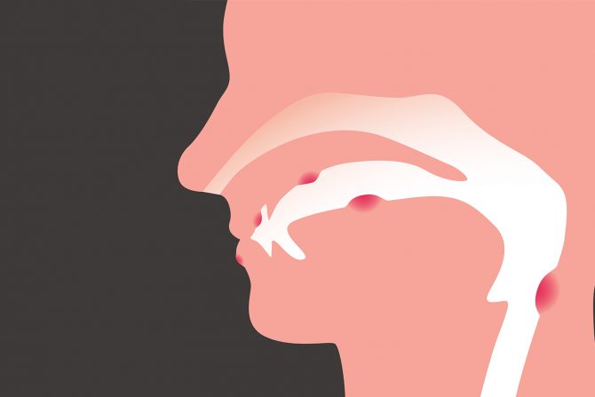 beli jezik- simptomi