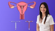 Spirala je kontraceptivno sredstvo, ali rešava i obilna krvarenja, priča nam dr Jelena Štulić