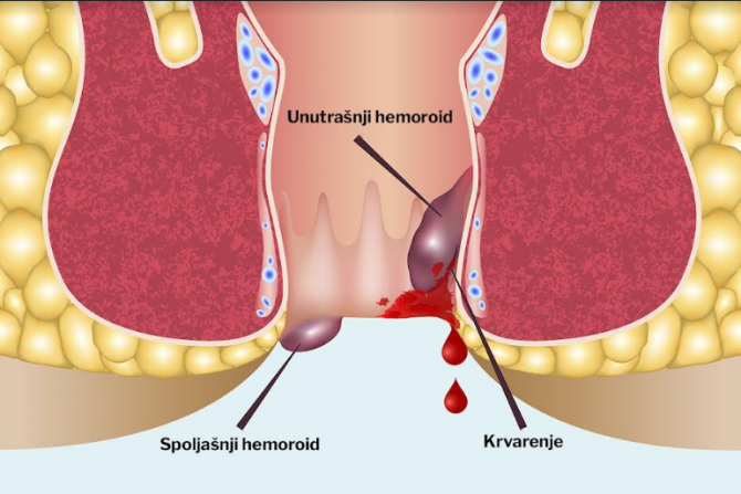 hemoroidi
